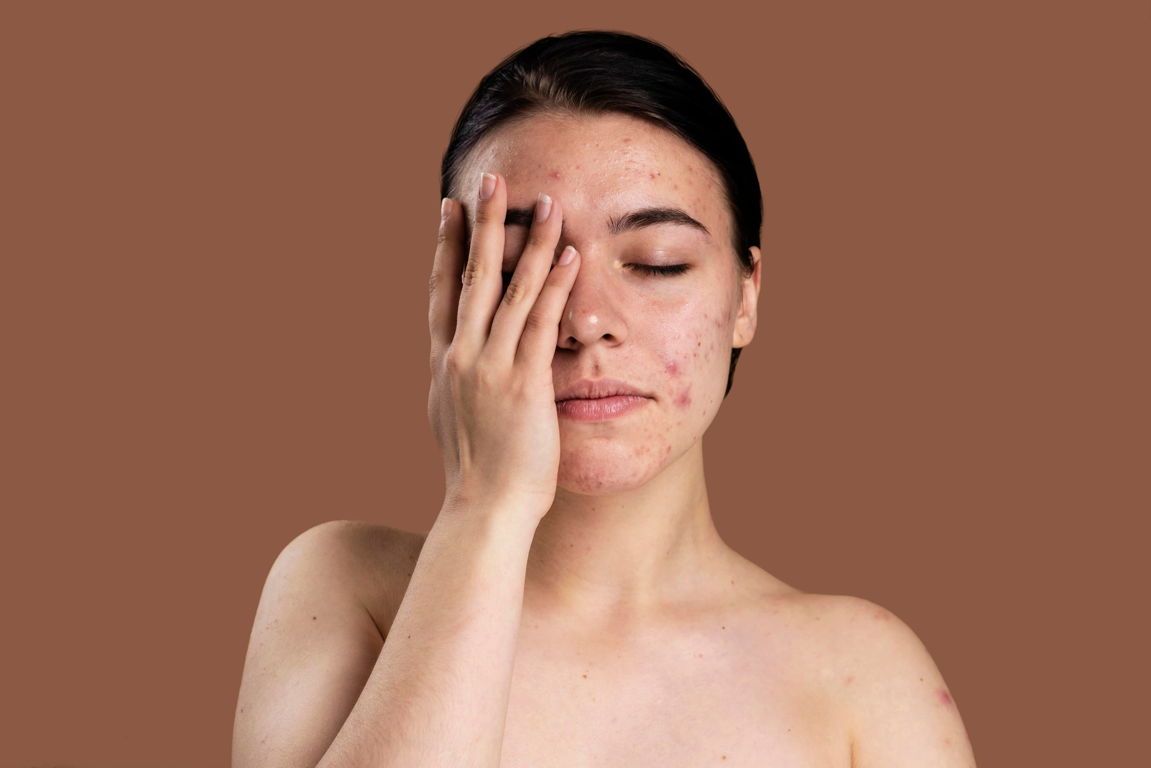 New Look What is Fungal Acne? Symptoms, Cure, Precursors, and Ingredients, Allergies, and Sensitivity to Chem blog